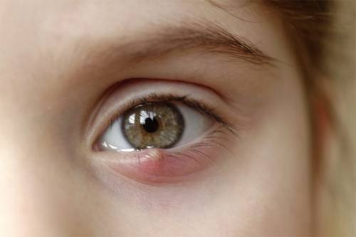 Home Remedies for Stye